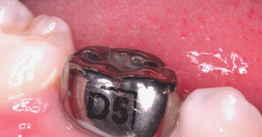 ORAL REHABILITATION Stainless steel crown prep on a primary molar odontobebe