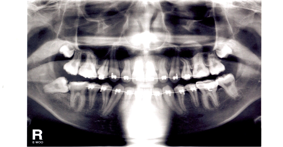 OrthoWorks Saving Impacted Molars