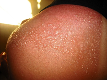 Keratosis Pilaris: Treat Those Bumps on the Back of Your ...