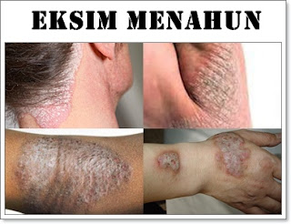 9 Obat Eksim Kering Menahun, Penyebab, dan Cara Mencegahnya