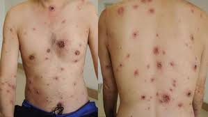 Obat Kencing Nanah Cefixime
