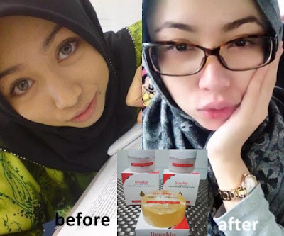 Obat Yang Mempan Untuk Mengatasi Flek Di Wajah Liyoskin Obat Yang Mempan Untuk Mengatasi Flek Di Wajah