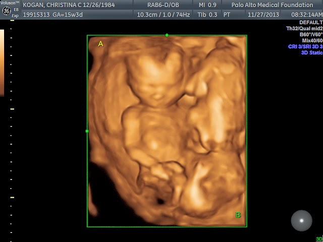 Kogan Twins: 15 week ultrasound
