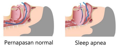 Sleep Apnea Pengobatan Sleep Apnea