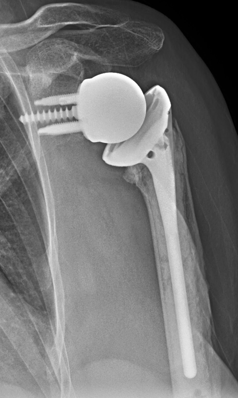 Djo reverse total shoulder image