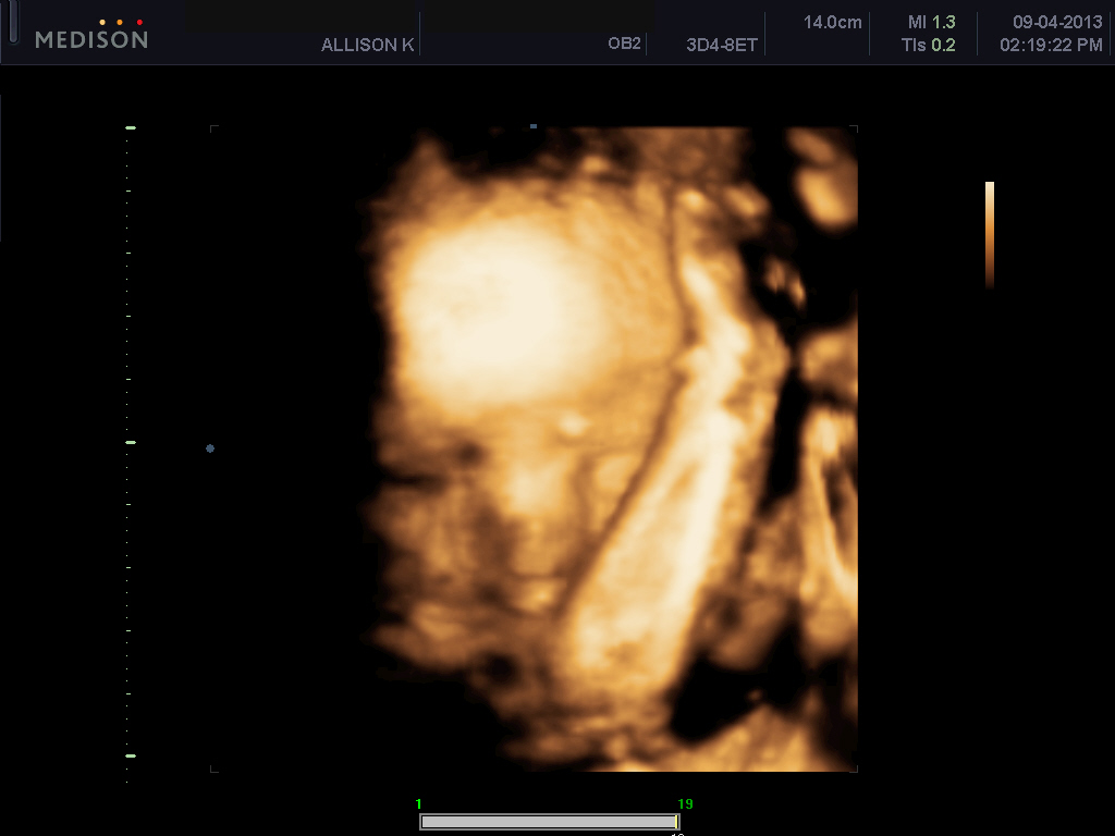 Baby Kniffin 3D/4D Ultrasound