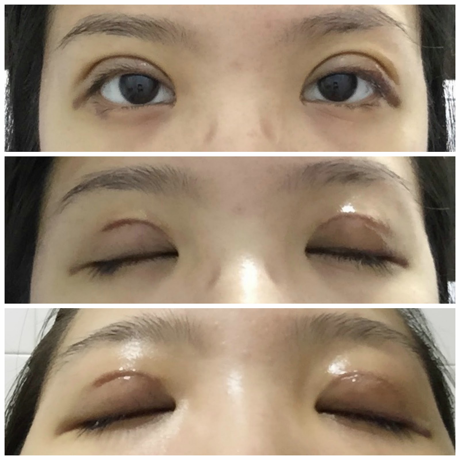 Double Eyelid Surgery My Double Eyelid Surgery