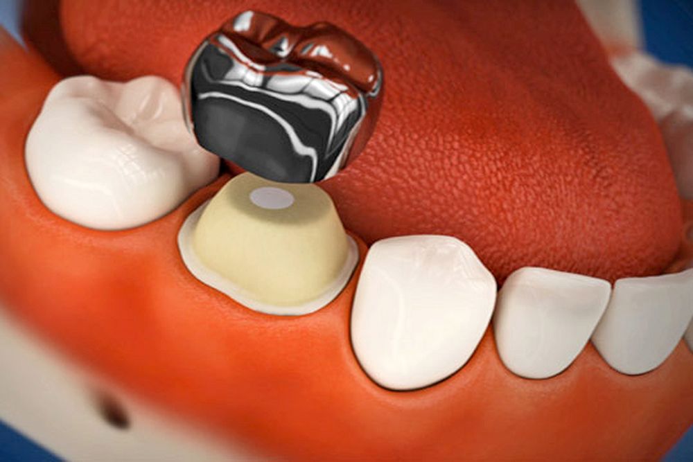 ORTHODONTICS Serial extraction of primary teeth OdontoVida