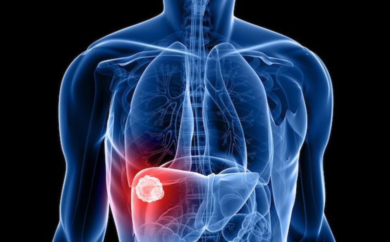 Liver Cancer Symptoms Signs Treatments Signs Of Liver Cancer - healtinews