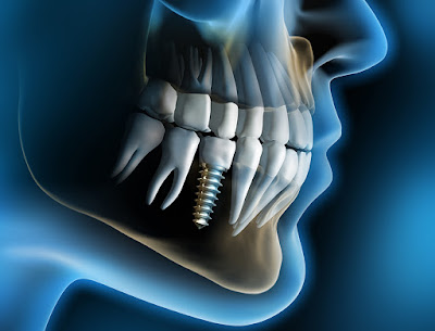 Trồng răng implant giá bao nhiêu tiền?