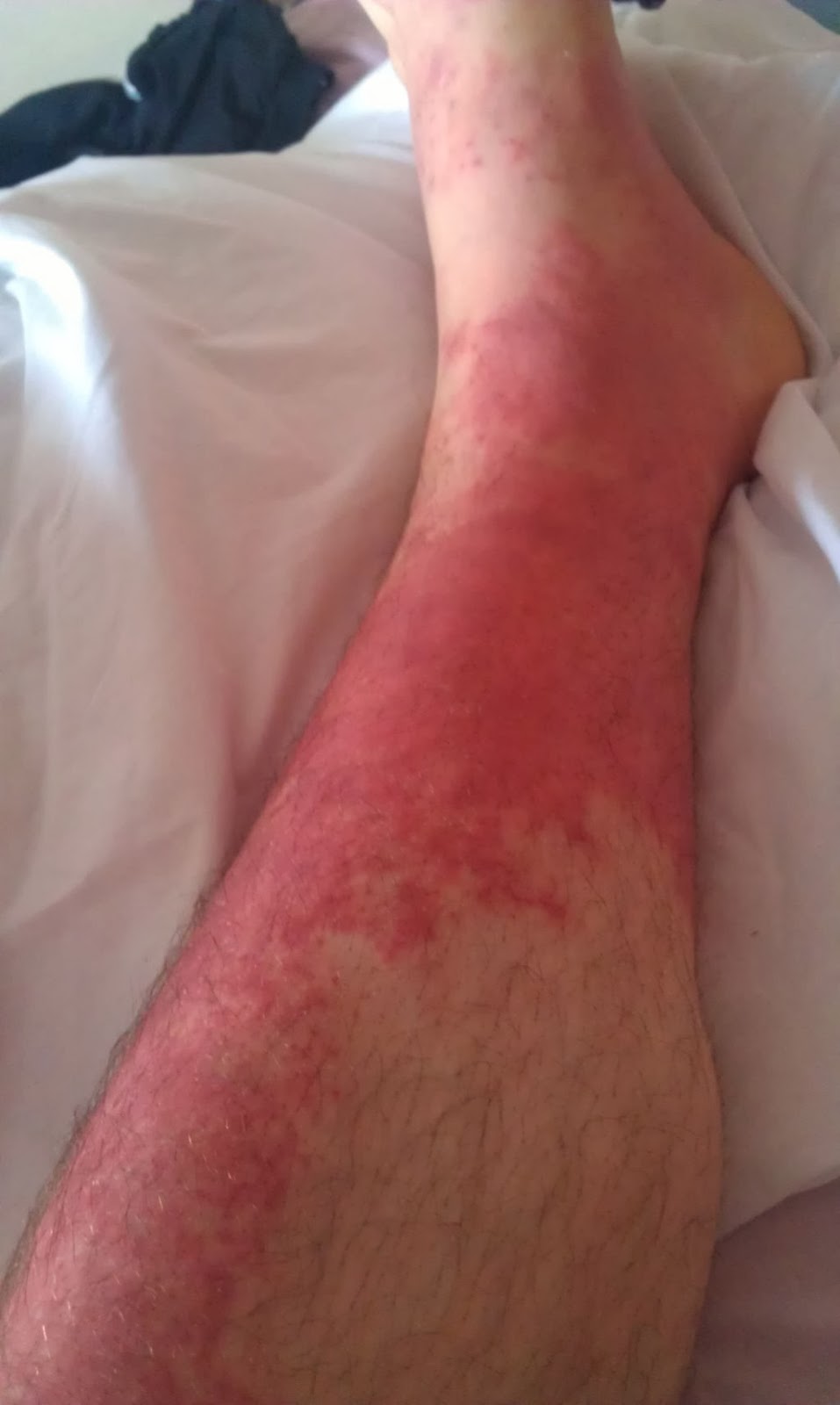 rash on legs #9