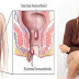 Jual Obat Wasir Herbal thumbnail