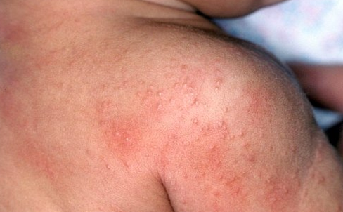 Chikungunya Bukhar Se Bachne Ke Upay