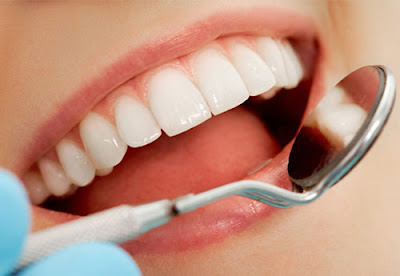 Bọc răng sứ thẫm mỹ chất lượng cao