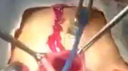 Shocking! Watch as Surgeons Remove More Than 20 Toothbrushes From Patient's Stomach (Graphic Video)