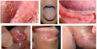 Obat Kondiloma Ampuh Obat Kondiloma Ampuh