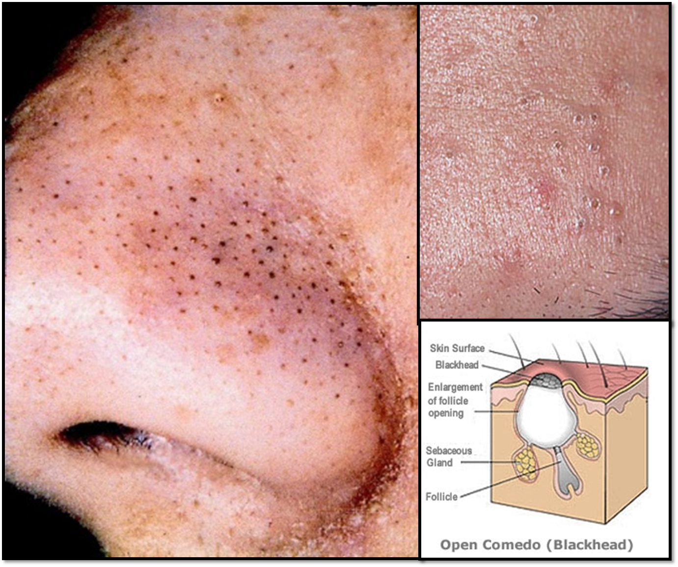 Mama Comel Arissa Vitamin E Hilangkan Blackhead dan Whitehead