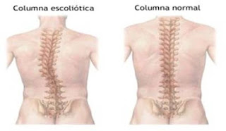 Estructura de la columna vertebral Cualquier nervio en la región de la columna puede ser dañado o aplastado, y esto puede causar mucho dolor crónico.