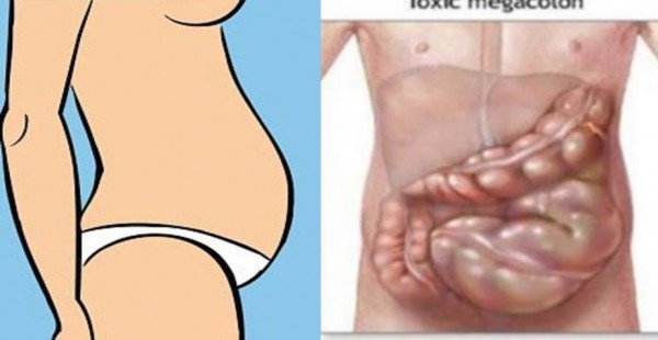 Your Are Not Fat! Your Stomach Is Bloated And Here Is How To Get Rid Of It