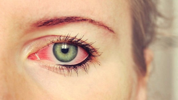 How to Quickly Treat Red Eyes Disease How to Quickly Treat Red Eyes Disease