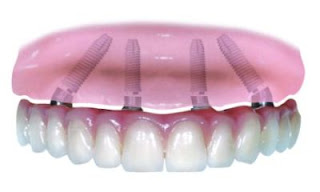 http://www.implantdentistindia.com/teeth-in-one-visit.html