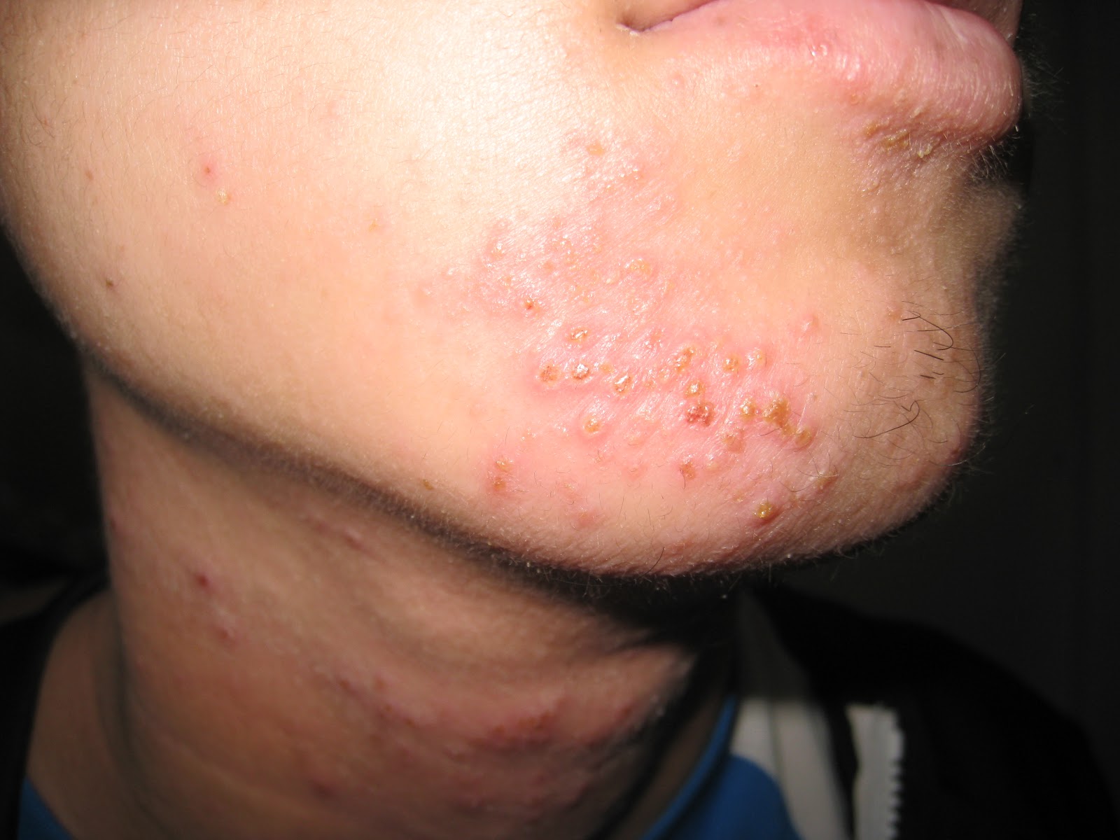 Eczema Herpeticum – What is it and is it dangerous ...