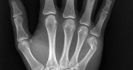 Young Athlete Center: Metacarpal Fracture