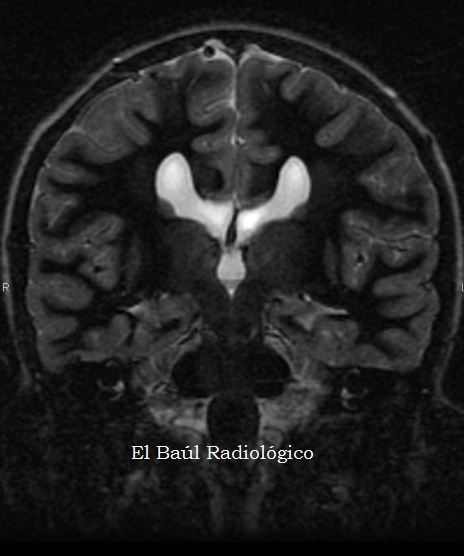 agenesia parcial de la resonancia del cuerpo calloso