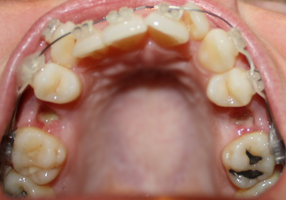 TRATAMIENTOS DENTALES ¿Porque son necesarias extracciones en