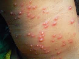 Foto Cara Pengobatan manjur menyembuhkan Penyakit Herpes Atau Cacar Api