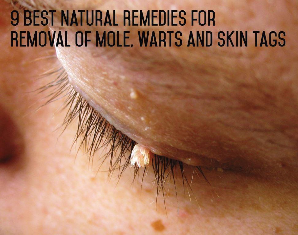 Best Natural Mole Removal Best Natural Mole Removal