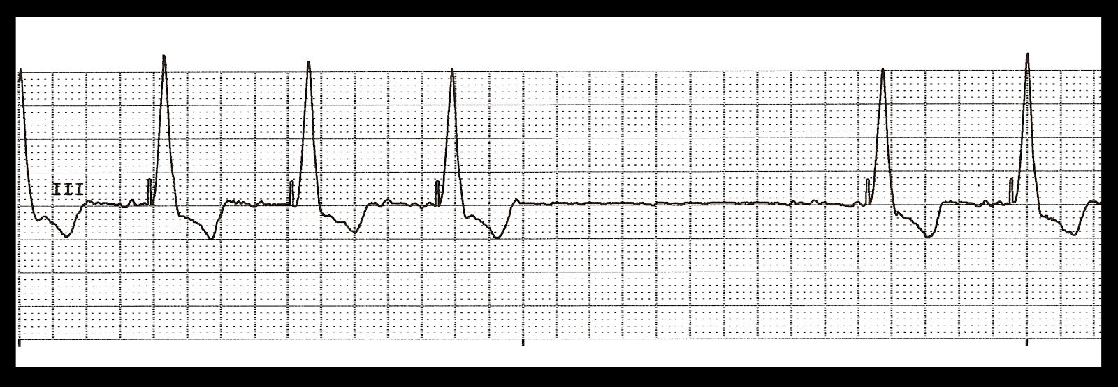 ventricular paced failure to capture ventricular paced failure to capture