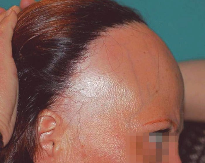 Почему болит кожа головы. Фиброзирующая колонопатия. Болит кожа головы и выпадают волосы. Фиброзирующая колонопатия что это такое симптомы. Фиброзная колонопатия симптомы.