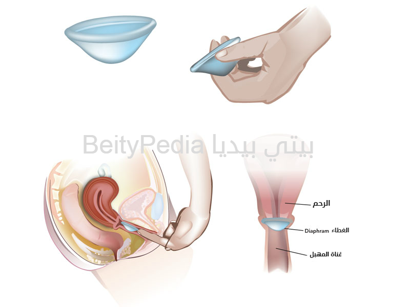 الوسائل العازلة لمنع الحمل بيتي بيديا