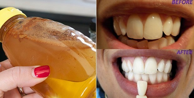 apple-cider-vinegar-gargle