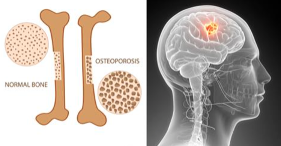 THIS COMMON DRINK DESTROYS YOUR BONES AND IS FULL OF CANCER-CAUSING CHEMICALS!