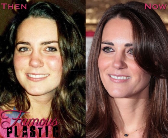 Kate Middleton Plastic Surgery Kate Middleton Plastic Surgery