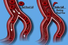 SICKLE CELL PATIENTS CAN LIVE A NORMAL LIFE FREE FROM ATTACKS. click on the image to know how