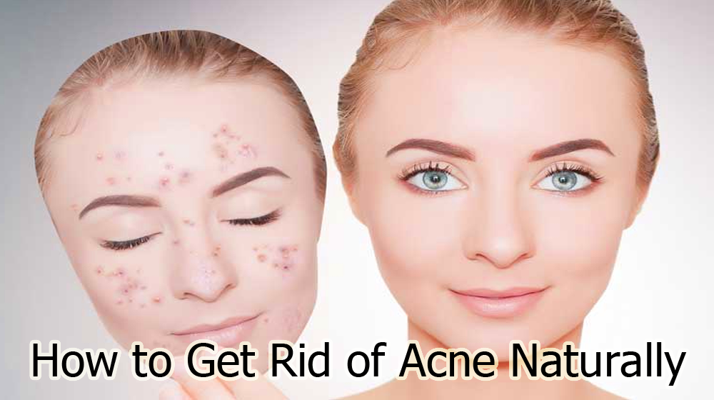 How to Get Rid of Acne Naturally