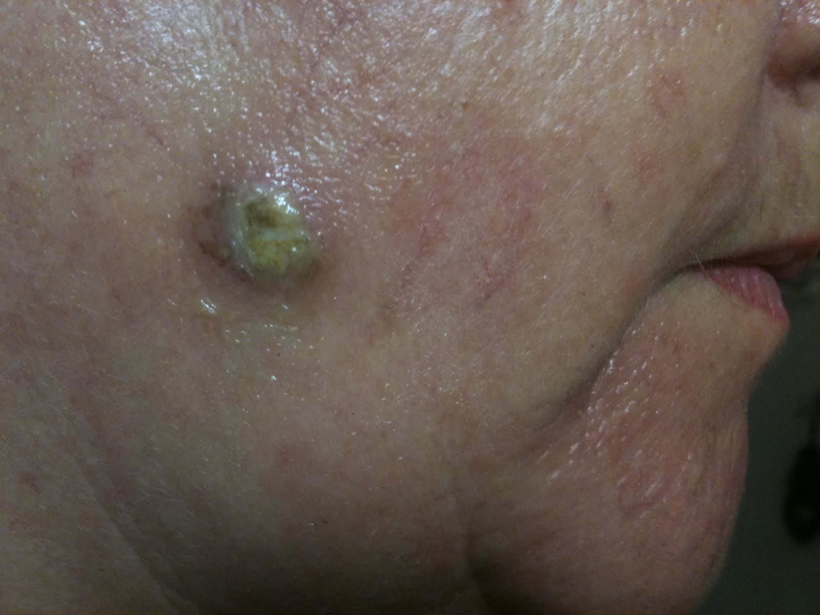 black-salve-my-experience