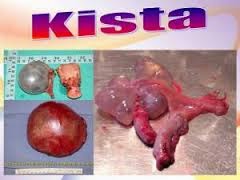 Penyebab Penyakit Kista Obat Sirosis Hati Alami Penyebab Penyakit Kista Obat Sirosis Hati Alami