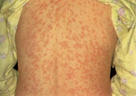 Sulfa Allergy and Sulfite Allergy - Verywell