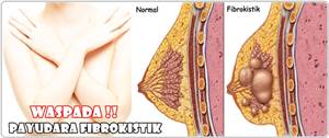 Obat Fibrokistik Payudara