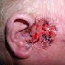 The signs of ear cancer may be these 5 symptoms, immediately check