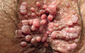 Obat Kutil Kelamin Alami cuka Obat Kutil Kelamin Alami cuka