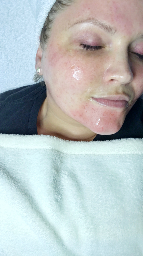 SelfCare, Microneedling + Before & Afters