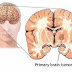 Causes And Signs Of Brain Cancer Disease In Human Body