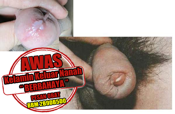 Cara Pengobatan Alternatif Kencing Nanah Terbaru