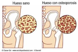 Osteoporosis en los ancianos