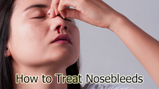 How to Treat Nosebleeds